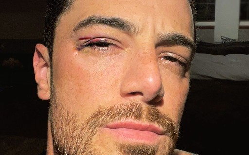 Felipe Titto mostra hematoma após bater rosto em janela de carro