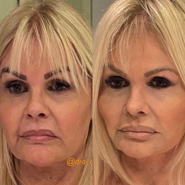 Monique Evans posta antes e depois de procedimento na face (Foto: Reprodução/Instagram)
