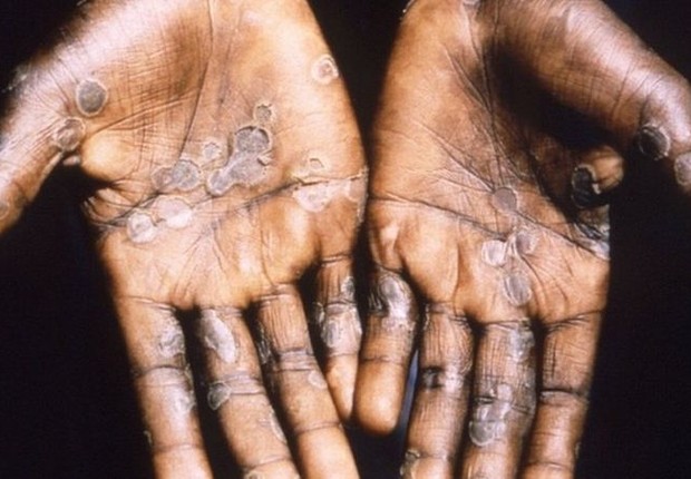 Mãos com varíola dos macacos (Foto: CDC)