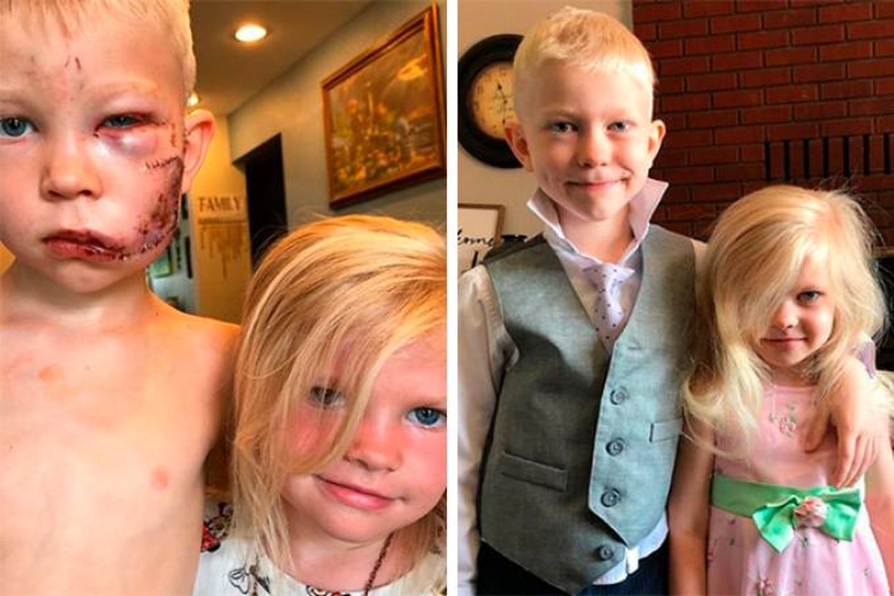 Bridger Walker e a irmã em dois momentos: após e antes do ataque canino — Foto: Reprodução/Instagram