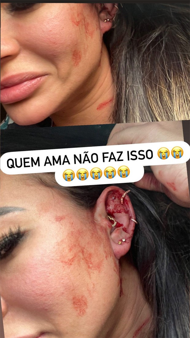 Milena Lins, influencer amiga de Carlinhos Maia, mostra lesões após agressões (Foto: Reprodução / Instagram)