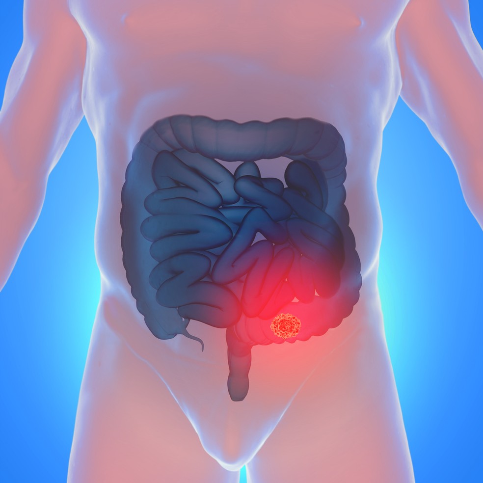 O câncer de intestino ou colorretal é uma doença caracterizada pelo surgimento de tumores malignos no cólon, que é uma parte do intestino grosso, além do reto e do ânus — Foto: Istock Getty Images