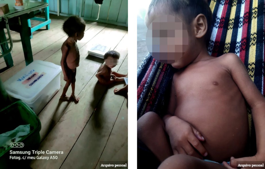 Crianças na região do Palimiú com quadro de desnutrição e malária