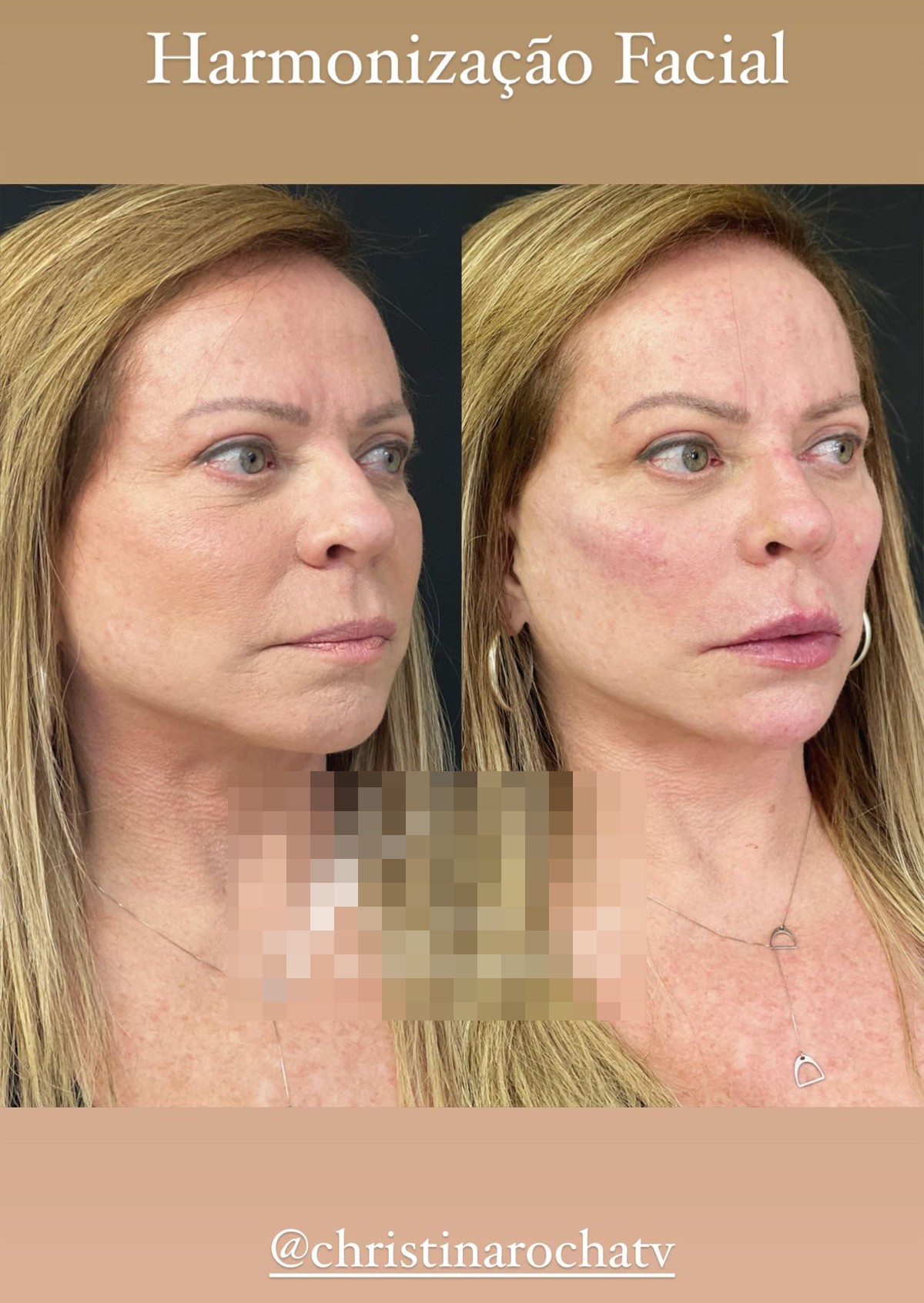 Christina Rocha antes e depois de harmonização facial (Foto: Reprodução/Instagram)