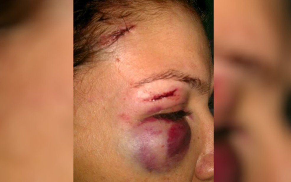 Ferimentos causados à ex-mulher de Murilo Neves em 2013 — Foto: Reprodução/AgMais