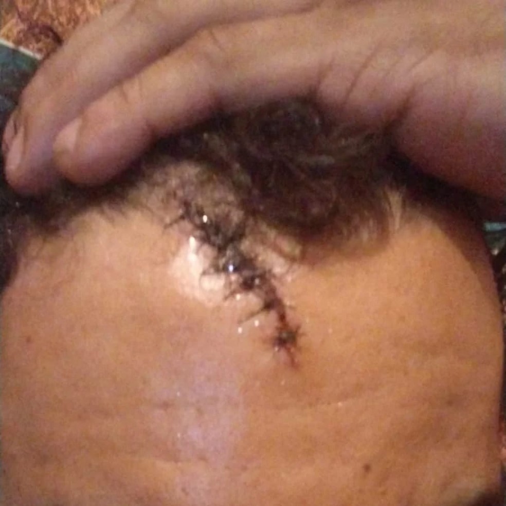 Folião levou 13 pontos na cabeça depois de ser golpeado por cassetete de agente de segurança — Foto: Reprodução/Divulgação