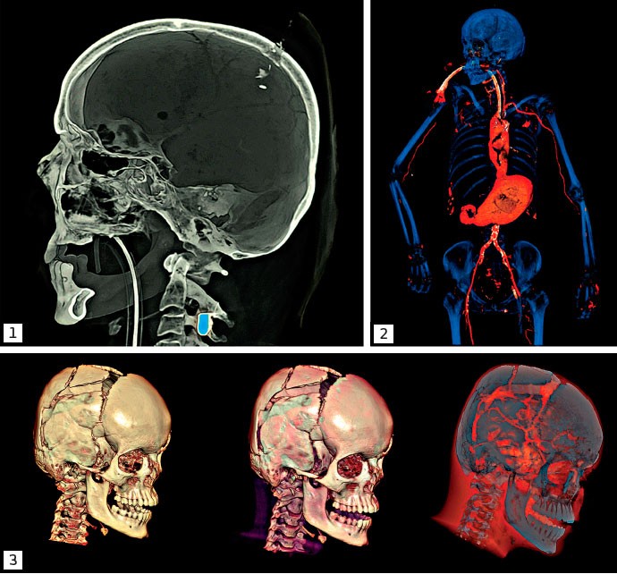 AJUDA-ROBÔ: Máquinas já acharam bala escondida na cavidade medular (1), sangramentos na ligação aorta-esôfago (2) e detalhadas fissuras no crânio (3) (Foto: Divulgação)