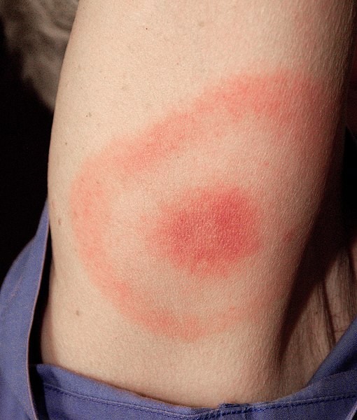 Vermelhidão e coceiras são sintomas da picada do carrapato transmissor da doença (Foto: Wikimedia Commons)