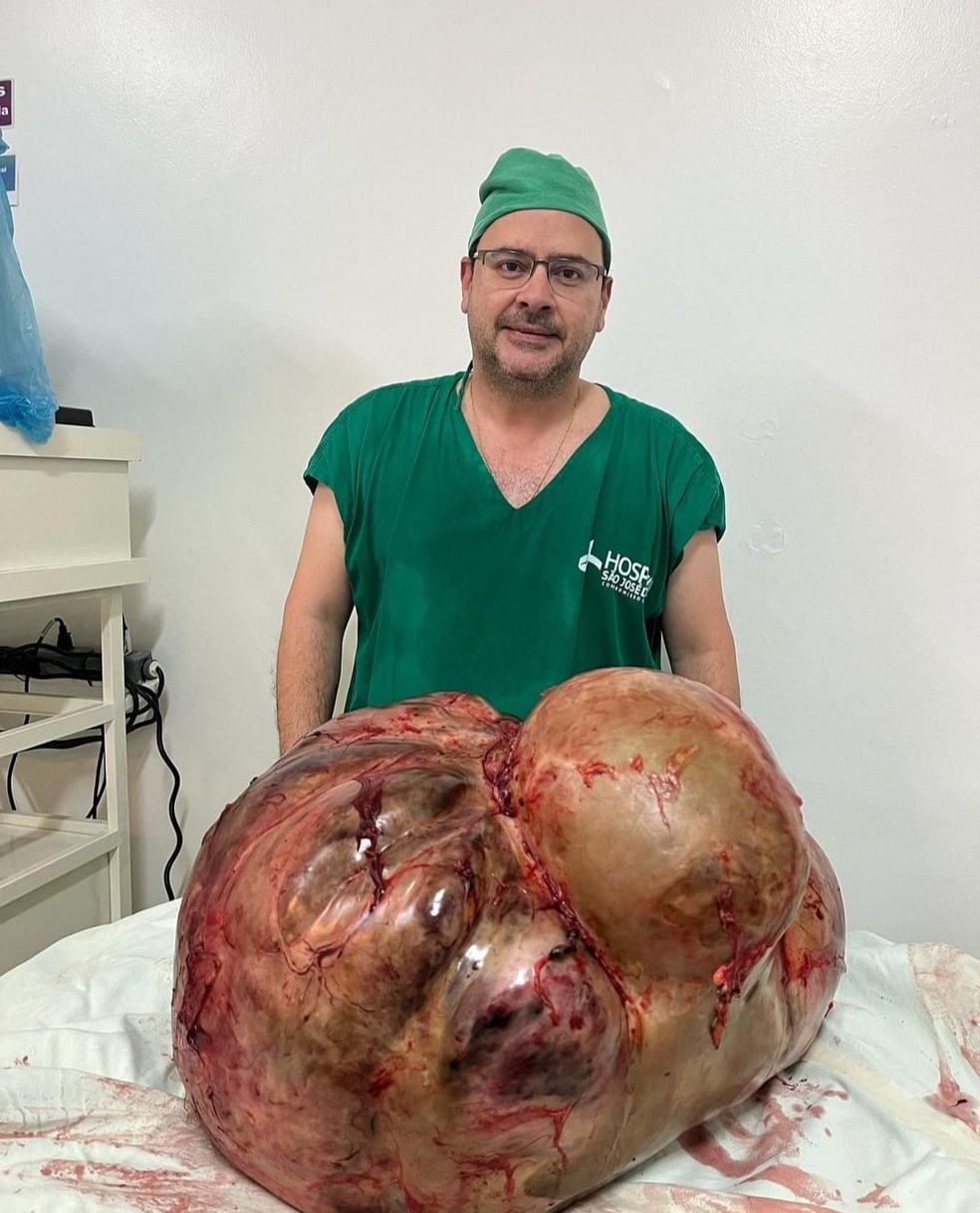 Tumor com cerca de 46 kg é retirado de paciente em Itaperuna, no RJ — Foto: Glaucio Boechat/arquivo pessoal