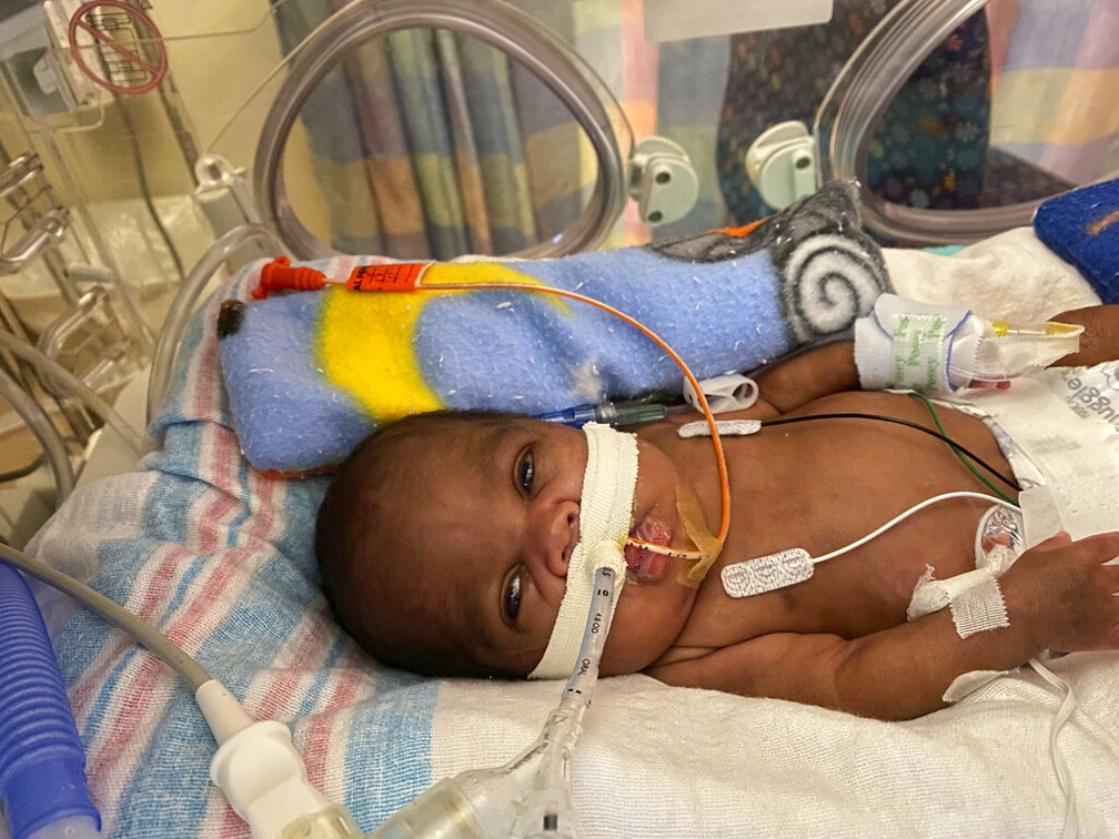 Curtis Means ficou meses ligado a um respirador após nascer com apenas 21 semanas de gestação no Alabama (EUA) — Foto: Michelle Butler/UAB University Relations via AP
