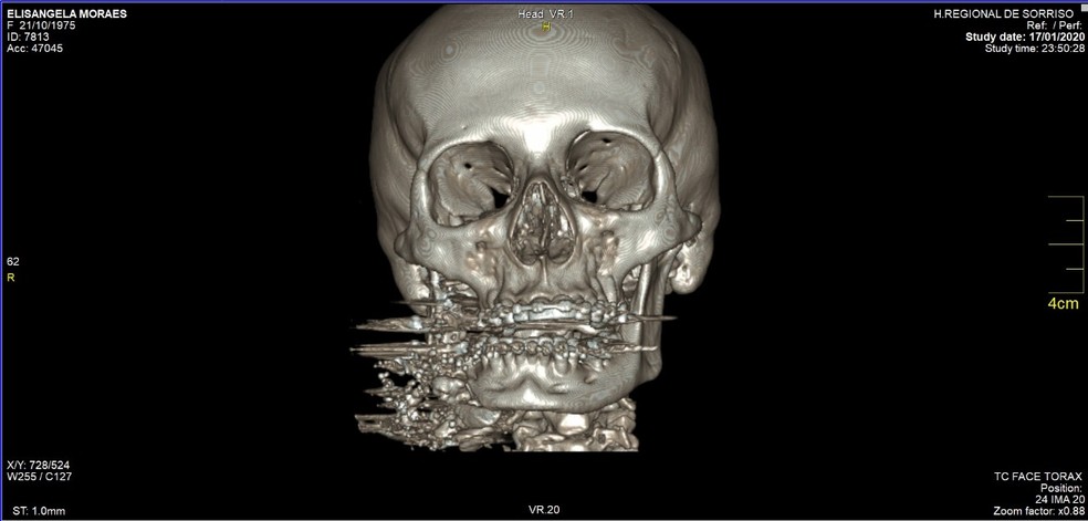 Raio-X mostra danos causados por tiro no rosto — Foto: Reprodução