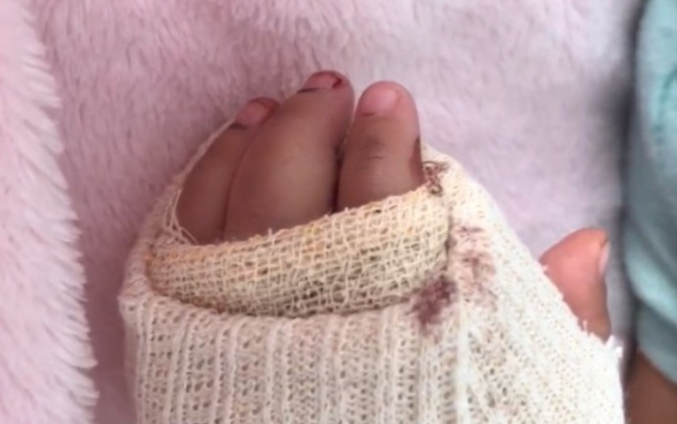 Criança que ficou com a mão presa em escada rolante na BA faz cirurgia para reconstrução dos dedos — Foto: Arquivo Pessoal