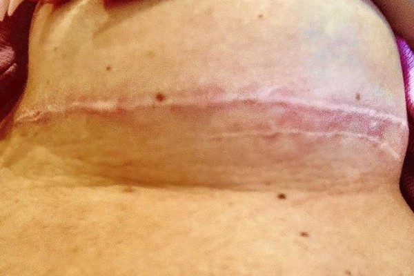 A imagem compartilhada pela influenciadora e estrela de reality show Laura Anderson mostrando a cicatriz em seu seio (Foto: Instagram)