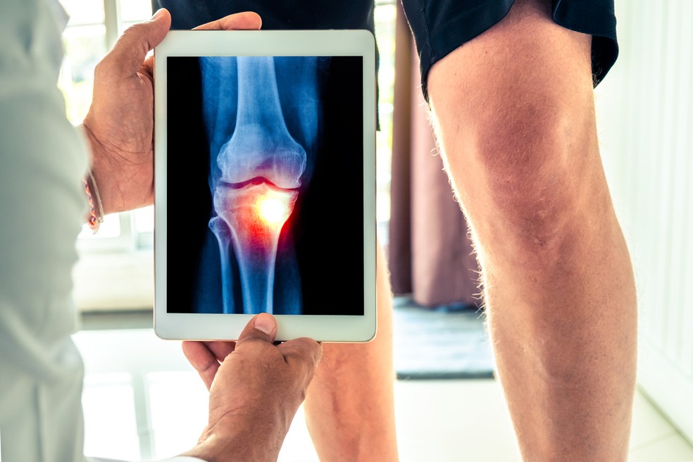 Artrose No Joelho Sintomas Como Tratar E Prevenir Saude Ge