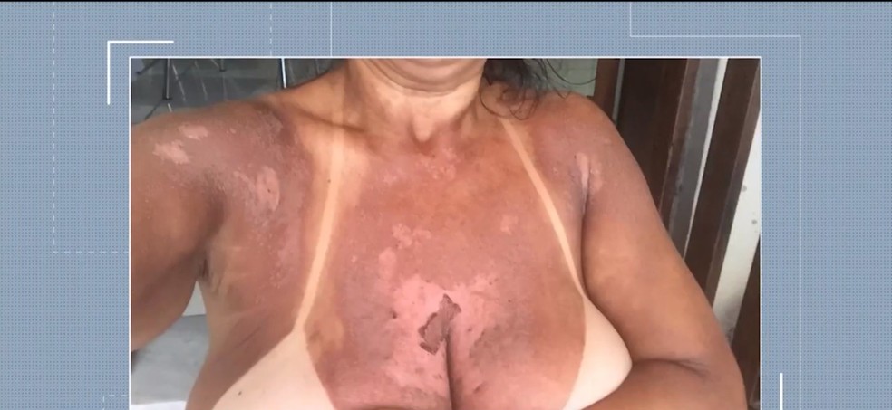 Quatro mulheres denunciam ter sofrido queimaduras apÃ³s serviÃ§o de bronzeamento natural com fitas em clÃ­nica â€” Foto: ReproduÃ§Ã£o/TV Santa Cruz