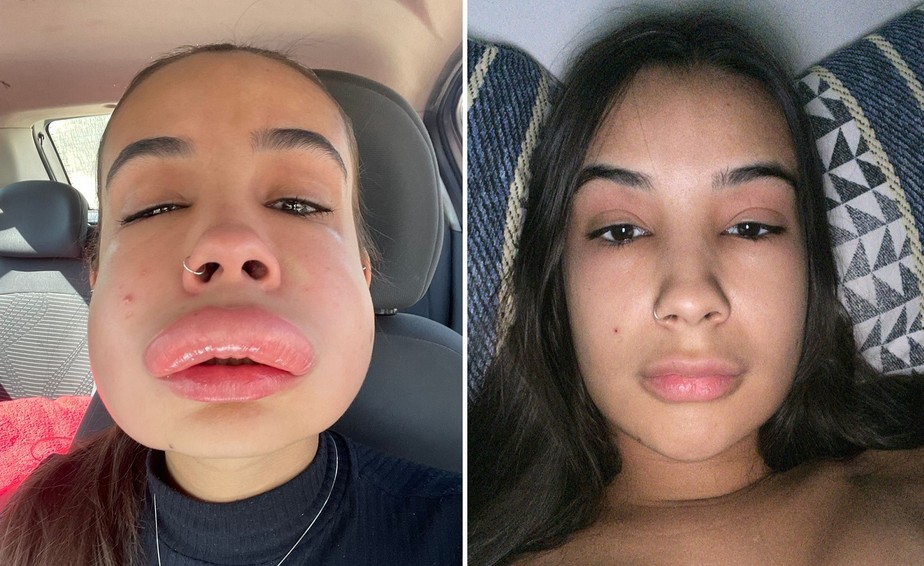 Antes e depois de Ísis Pinheiro após a alergia ao procedimento estético