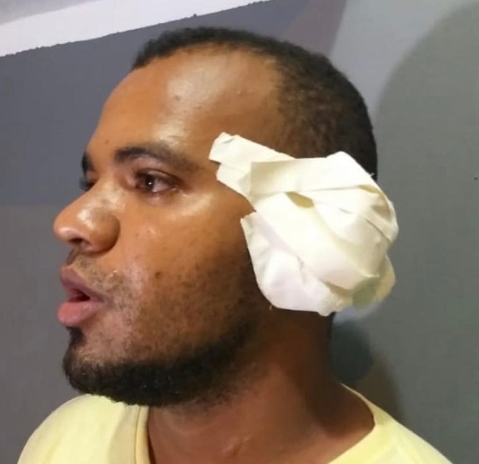 Thallyson da Silva ConceiÃ§Ã£o teve parte da sua orelha arrancada durante briga em festa em JoÃ£o Lisboa â€” Foto: DivulgaÃ§Ã£o/PolÃ­cia