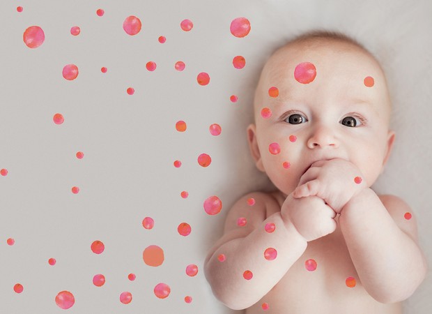 bebê; manchas; pele; vermelha (Foto: Crescer/ Editora Globo)