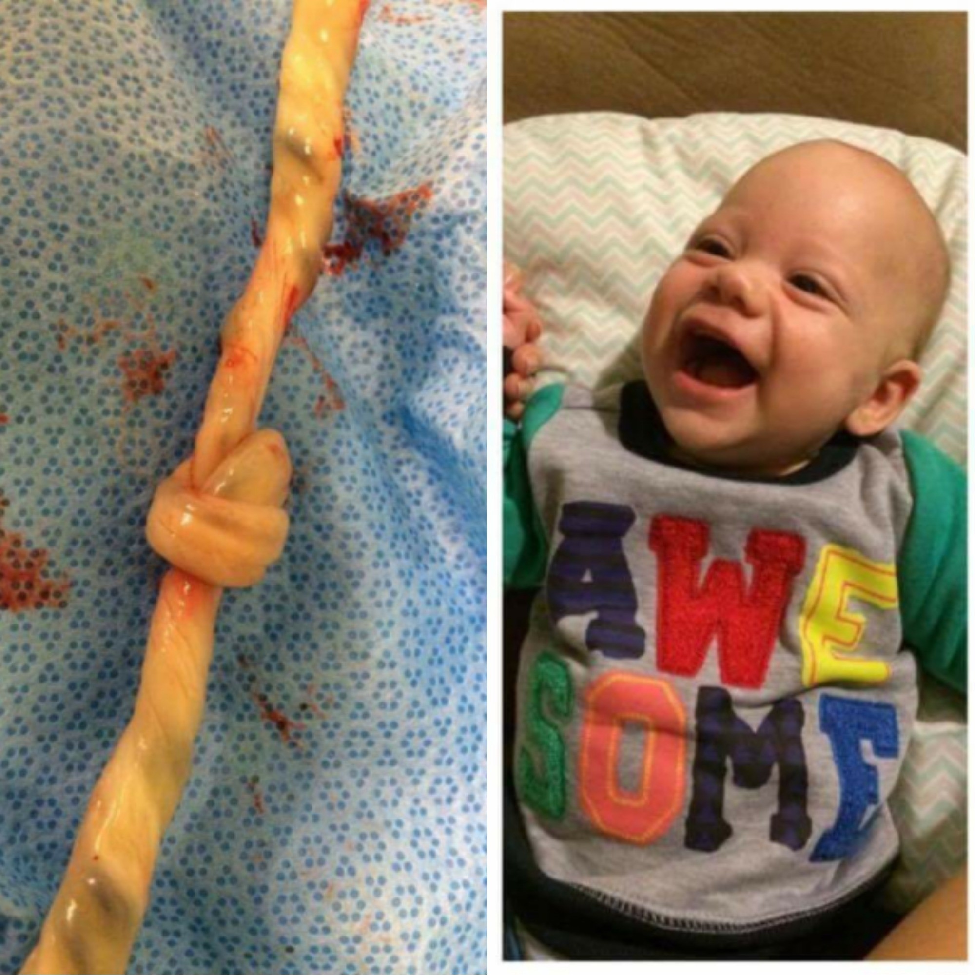 O nó no cordão e Orson quando bebê (Foto: Arquivo pessoal)