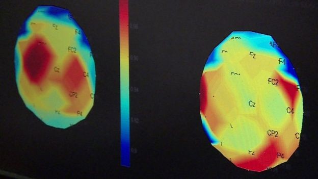 Partes do cérebro responsáveis pelos movimentos (em vermelho na imagem da esquerda) não estavam funcionando adequadamente. Após três meses de tratamento, essas regiões foram reativadas (Foto: BBC NEWS/WESTERN UNIVERSITY)