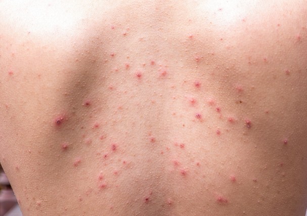 "Bacne" (Foto: Thinkstock) "Bacne" (Foto: Thinkstock)