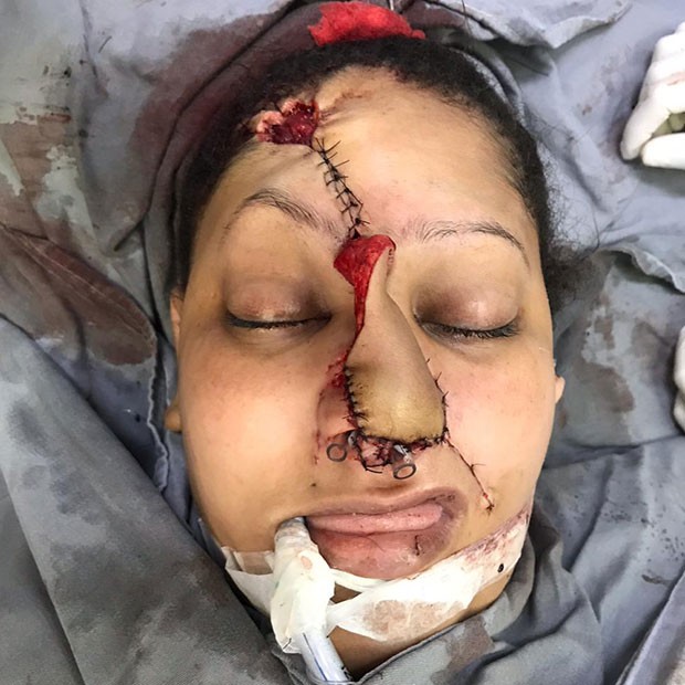 Talita Oliveira em sua primeira cirurgia de reconstrução do rosto (Foto: Arquivo pessoal)