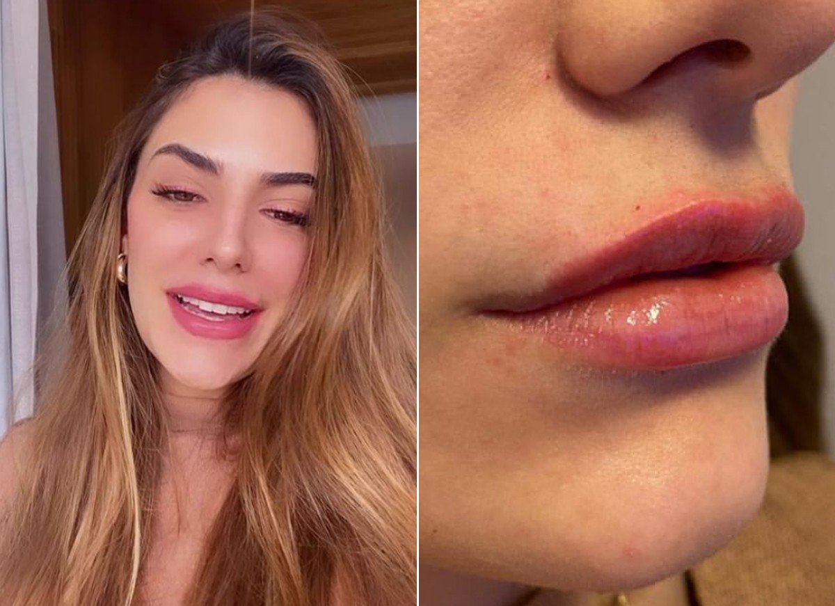 Jade Magalhães faz preenchimento labial (Foto: Reprodução / Instagram)