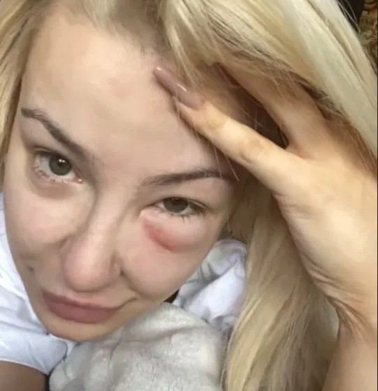 A youtuber Tana Mongeau com os olhos inchados (Foto: Instagram)
