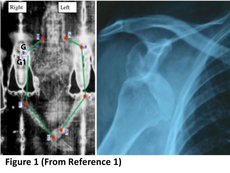 Imagem no Sudário Sudário sugere ombro deslocado, segundo pesquisa  (Foto: Bevilacqua, M et al/Catholic Medical Quarterly)