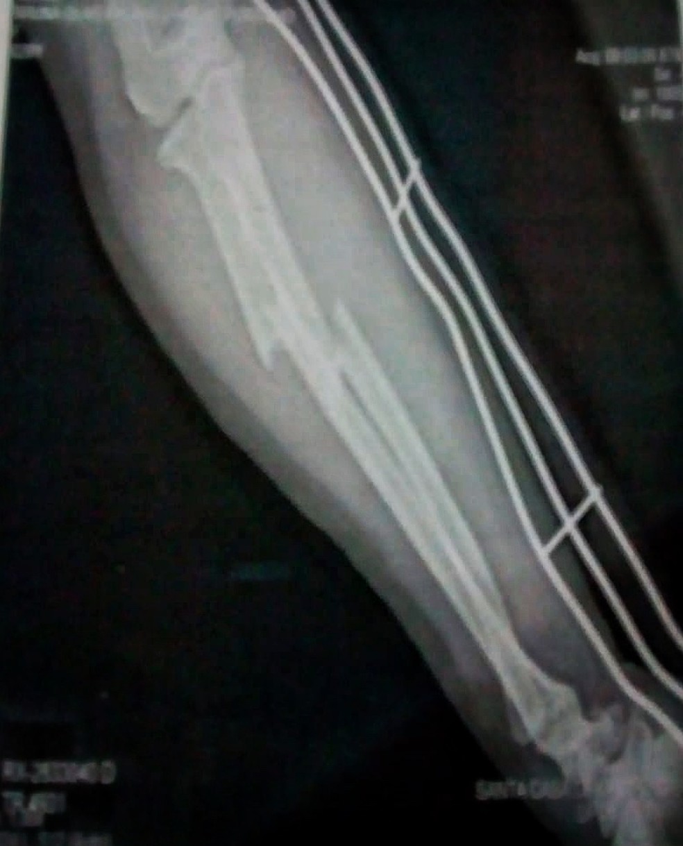 Bruna teve o braço quebrado em 2 lugares com um pé de cabra (Foto: Arquivo pessoal )