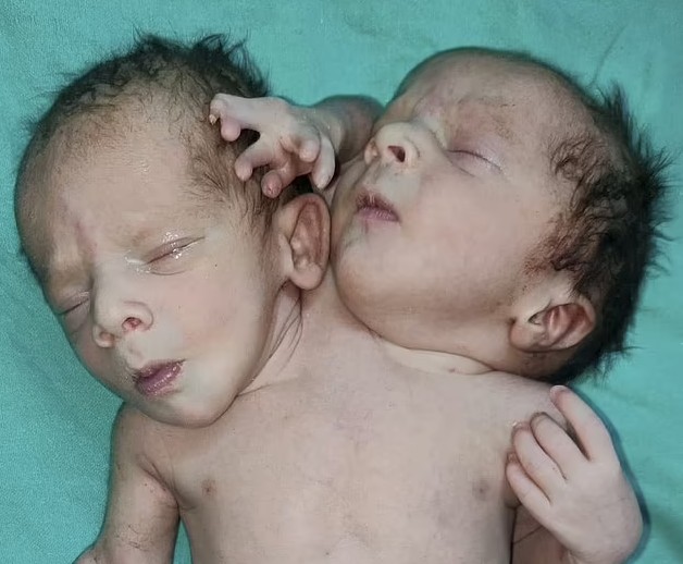 Gêmeos siameses nascem com três braços  (Foto: Reprodução Daily Mail )