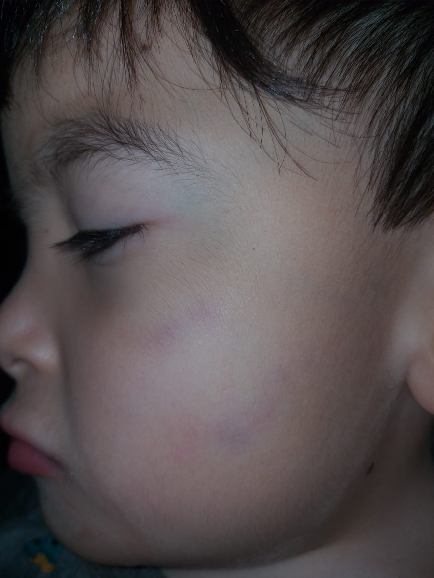 Recentemente, Guilherme chegou em casa com o rosto marcado por uma mordida (Foto: Arquivo Pessoal)