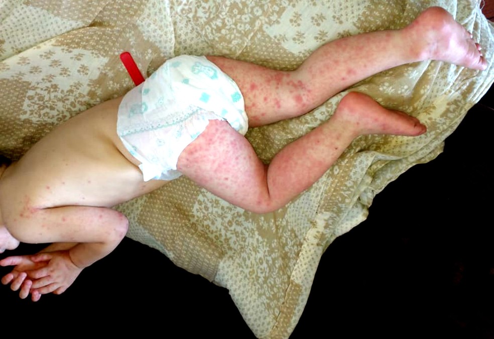 Surto Da Sindrome Da Mao Pe Boca Muda Rotina De Creche No Interior De Sp Bauru E Marilia G1