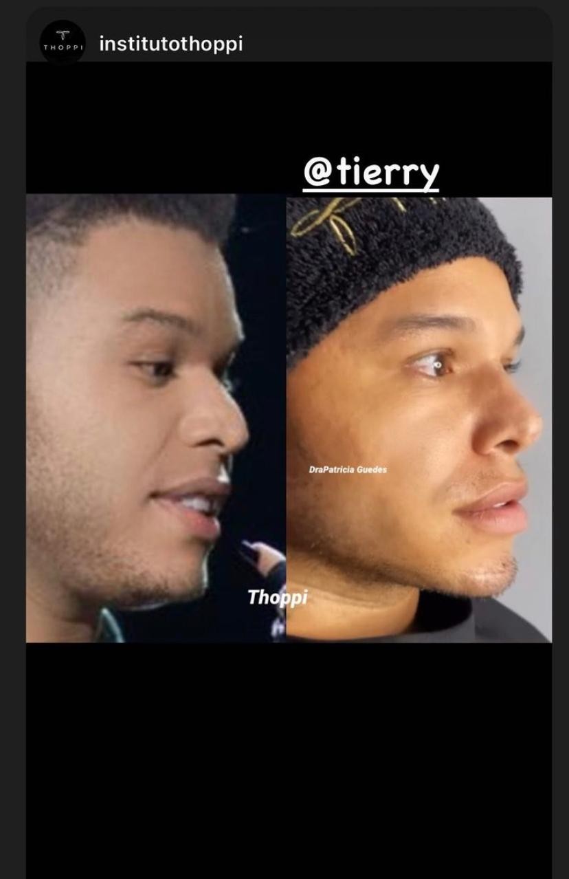 Gabi Martins e o namorado, Tierry, fazem harmonização facial juntos (Foto: Reprodução/Instagram)