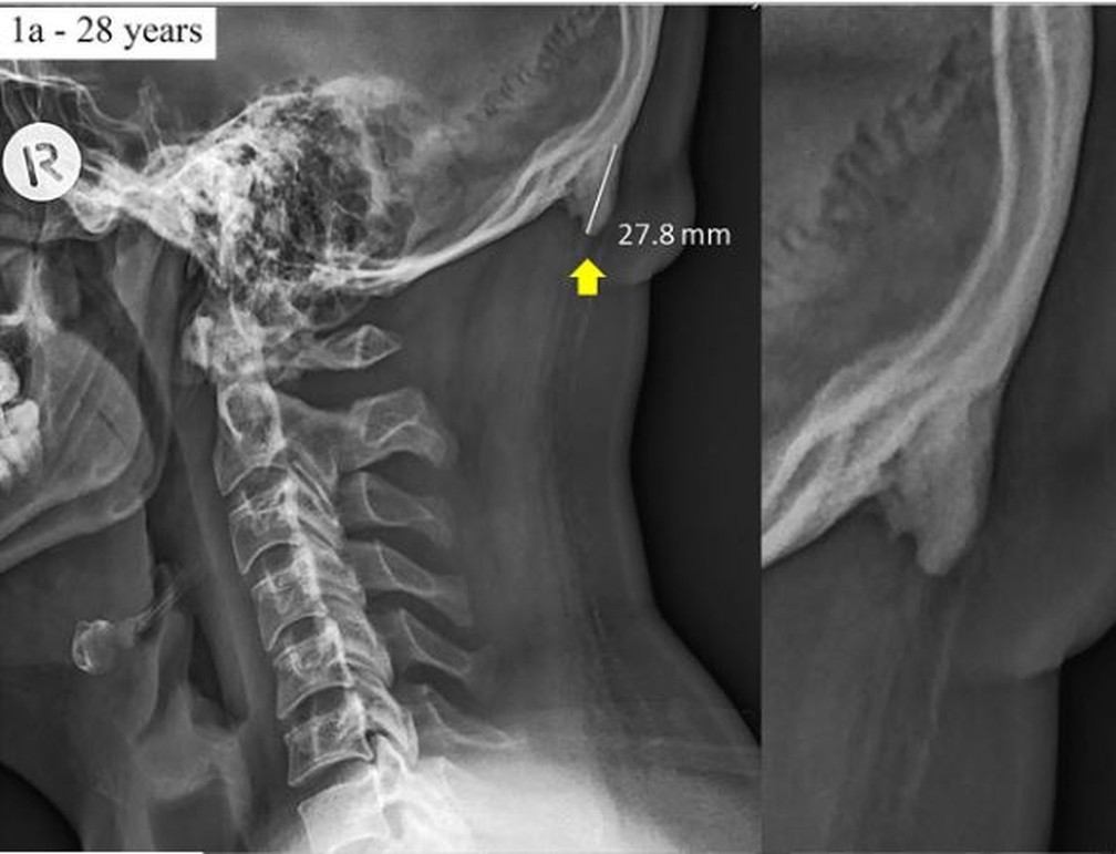 Imagem de protuberância na parte de trás do crânio; para pesquisadores da Austrália, ela é causada por dobrar a cabela para olhar o smartphone — Foto: Reprodução/Nature