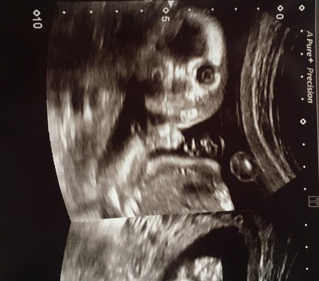 Ultrassom do bebê de Joanne Greer, do Reino Unido (Foto: Reprodução/Instagram/ Jo Greer)