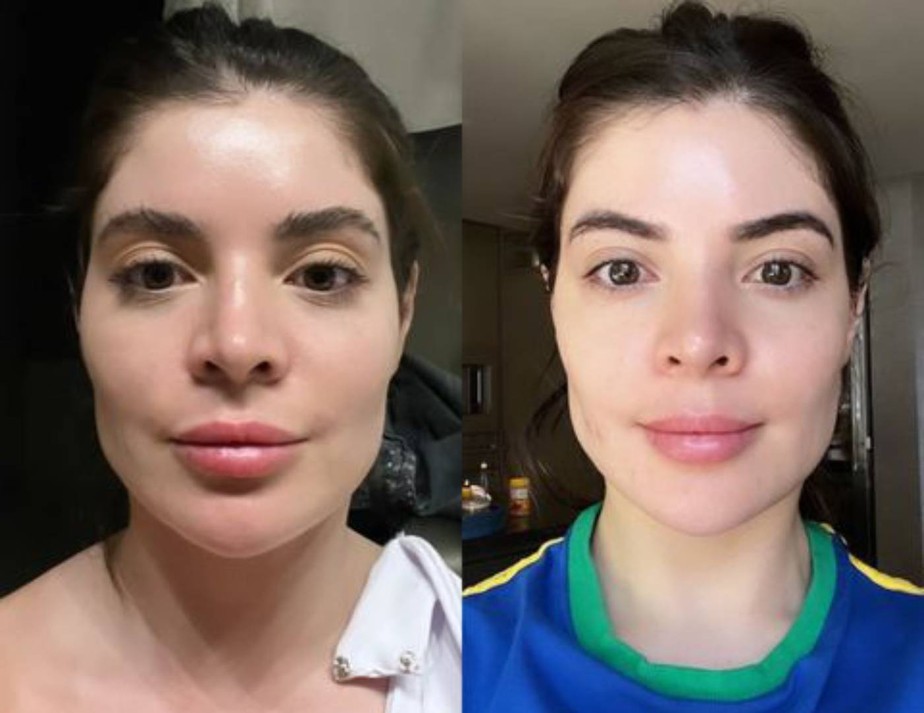 Gkay mostra antes e depois de retirar preenchimento no rosto