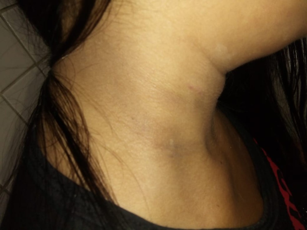 Marcas de estrangulamento e faca no pescoÃ§o da vÃ­tima de assalto em OriximinÃ¡ â Foto: MÃ¡rcio Garcia/DivulgaÃ§Ã£o