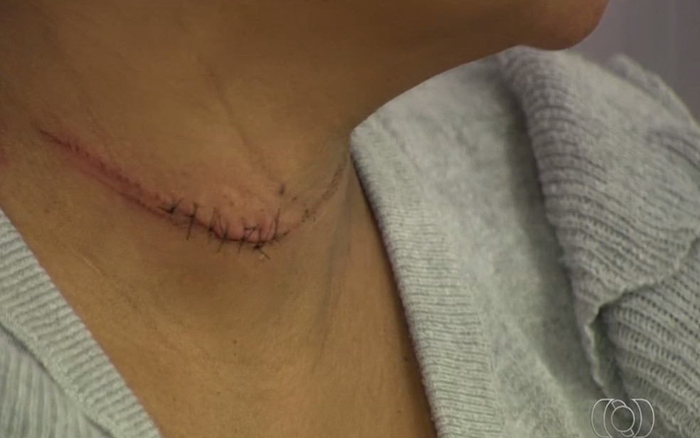 Viviane Ribeiro teve que levar sete pontos no pescoo aps ser atingida na moto por linha com cerol, em Goinia  Foto: Reproduo/TV Anhanguera