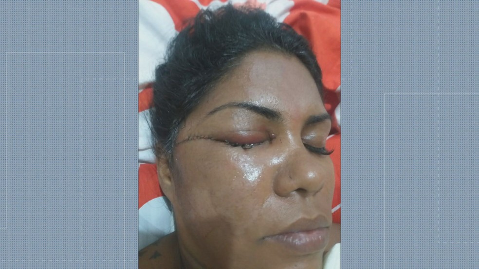 Bruna Vaz perdeu a visão do olho direito após ser atacada  — Foto: Reprodução/TV Globo 