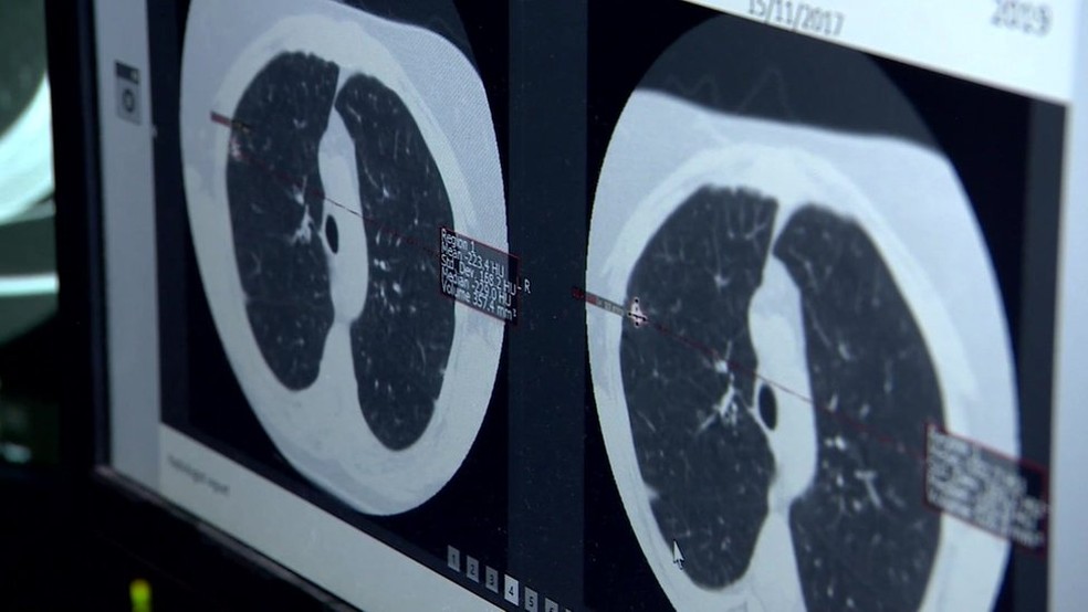 O cancêr de pulmão costuma dar sinais muito precoces de sua existência (Foto: BBC)
