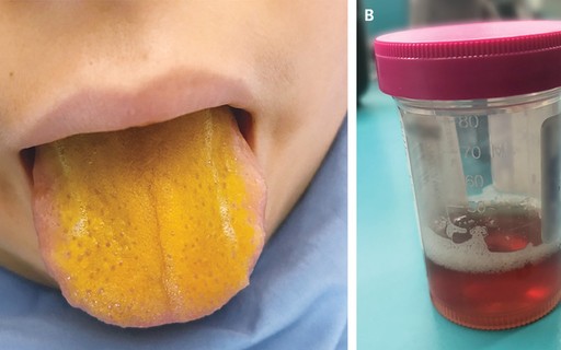 menino de 12 anos com lingua amarela e diagnosticado com doenca autoimune rara revista crescer saude