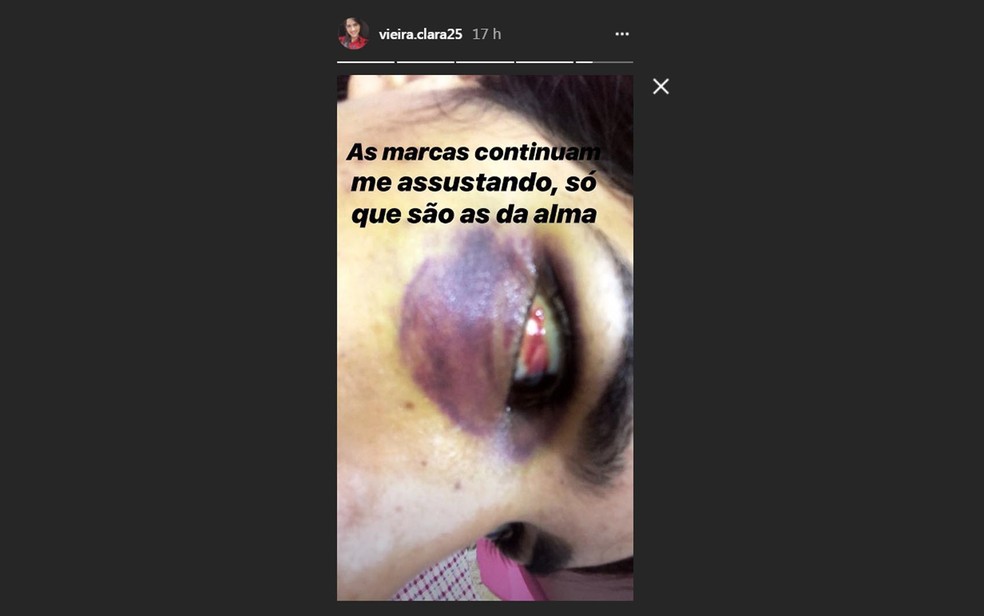 Jovem publicou imagens com marcas de agressÃ£o no rosto que teria sido provocada por ex (Foto: ReproduÃ§Ã£o/ Instagram)