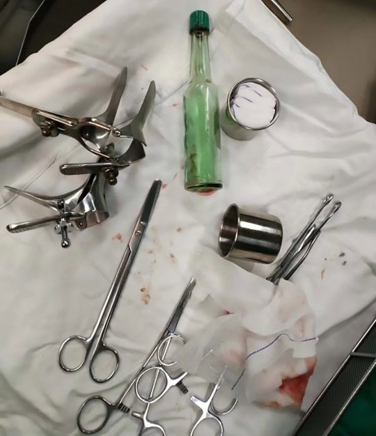 Objeto de vidro tinha 5 centímetros de diâmetro e foi removido em cirurgia (Foto: Dongguan Hospital of Western and Traditional Chinese Medicine in China)