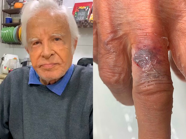 Cid Moreira machuca o dedo e faz reflexão sobre a idade (Foto: Reprodução/Instagram)