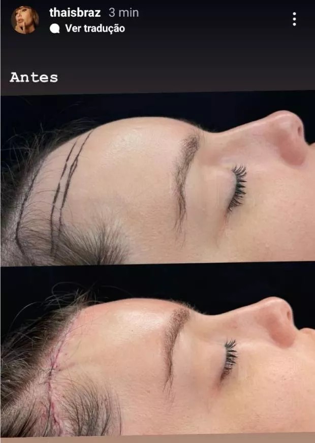 Thais Braz mostra antes e depois da cirurgia de Frontoplastia (Foto: Reprodução/ Instagram)