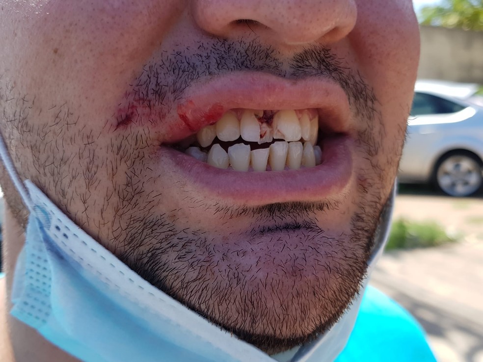 Motorista por aplicativo foi agredido no rosto — Foto: Sara Cardoso/Inter TV Cabugi