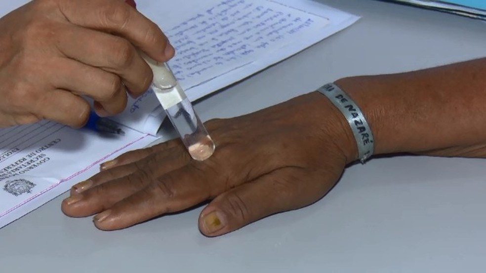 Em Menos De Quatro Meses Casos De Hanseniase No Ap Ultrapassam Registros Da Doenca Em 2018 Amapa G1