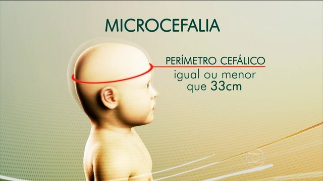 microcefalia jornal hoje (Foto: Tv Globo)