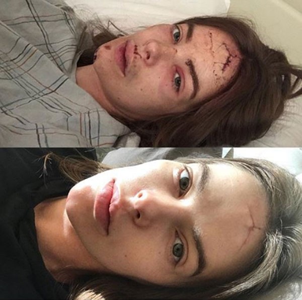 Robyn Lawley, de 29 anos, postou uma imagem que mostra seu rosto ainda com pontos e outra em que aparece a cicatriz na testa em seu Instagram (Foto: Reprodução/Instagram)